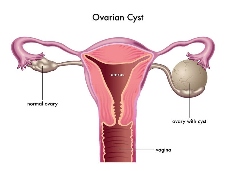 Ovarianzysten